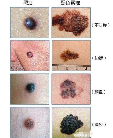 腋下有凸痣|点痣不正规可能引发癌变：关于痣的 4 个常识